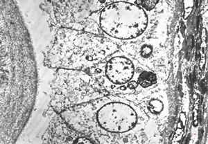 M,46y. | prostate - residual lysosomes M,46y. | prostate - residual lysosomes